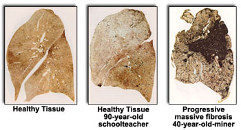 Lungs